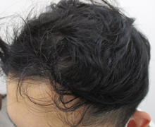 2年1カ月後前頭部左