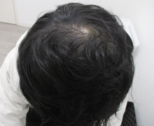 2年1カ月後頭頂部