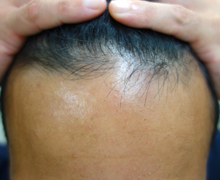 施術後2年0.5カ月