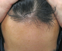 施術後7年6.5カ月