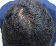 施術後2年0.5カ月