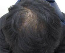 施術後7年6.5カ月